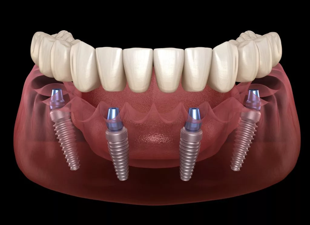 Implant Dentistry Everett